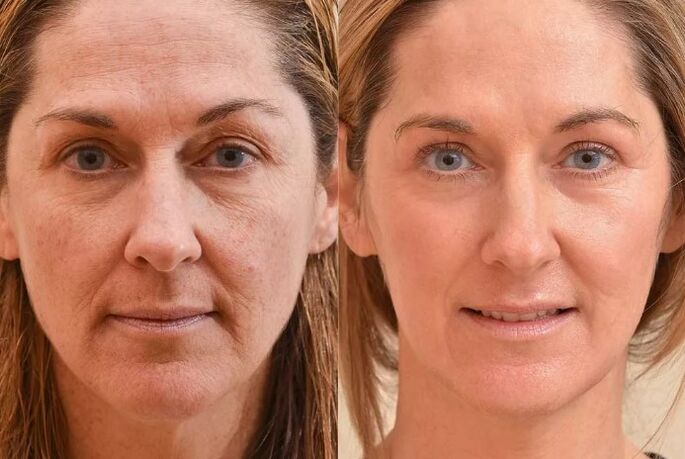 Rejuvenation of the face before and after