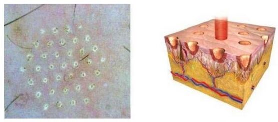 The fractional laser affects the point of the skin