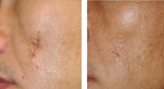 The laser result
