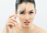 Girl after fractional laser facial rejuvenation.