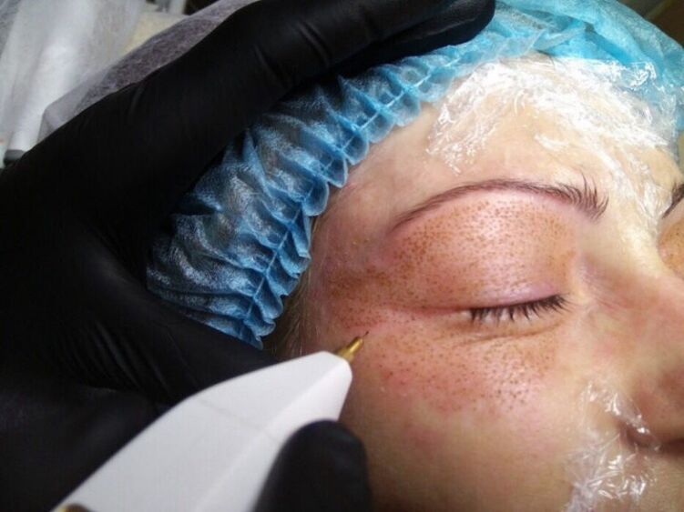Plasma lifting procedure.