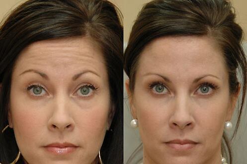 Botulinum toxin injections are suitable for use in any area of ​​the face.
