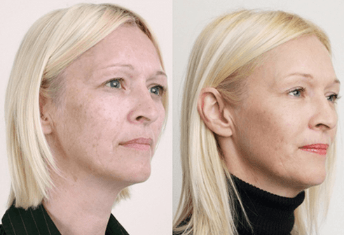 Medium peeling with fruit acids.