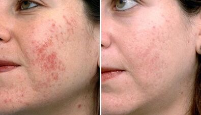 Photos before and after fractional skin rejuvenation.