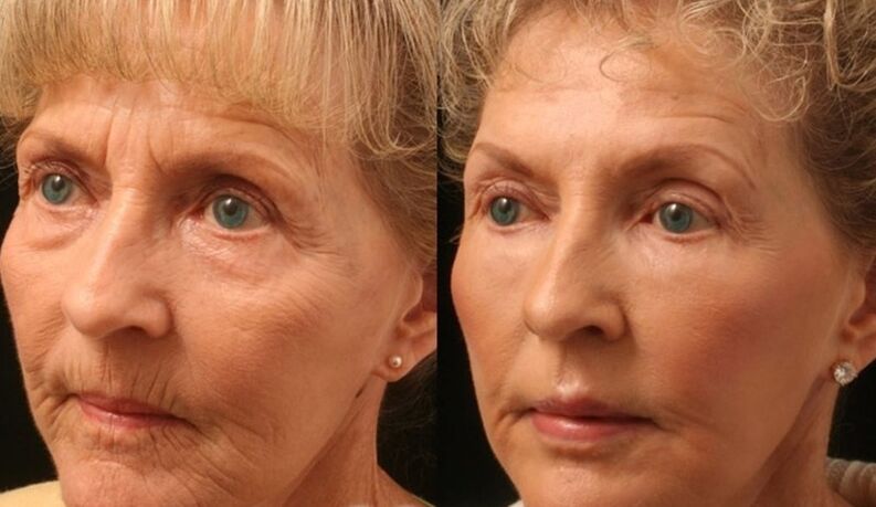 photo before and after fractional laser resurfacing