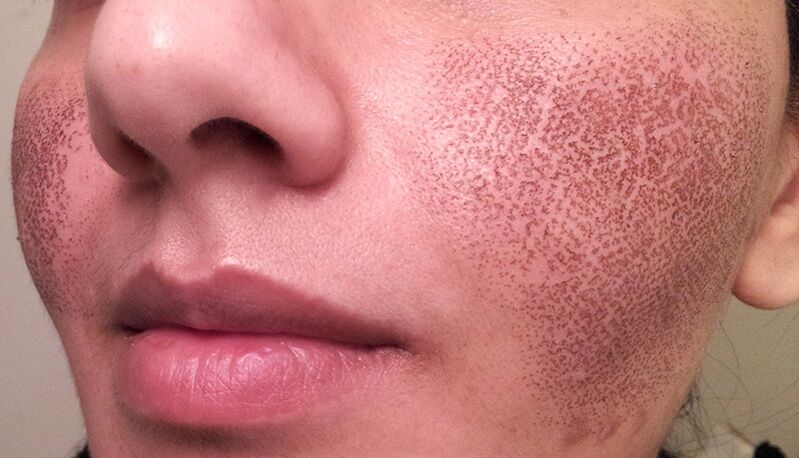 skin after fractional laser resurfacing