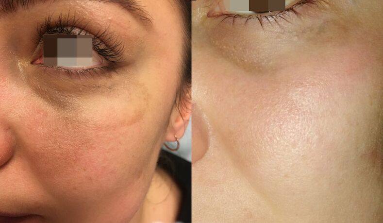 skin before and after fractional laser resurfacing