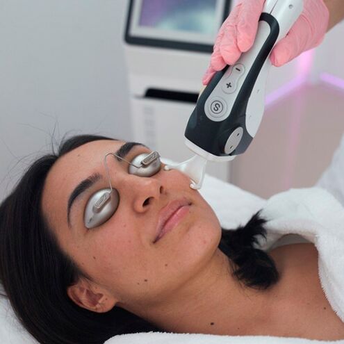 Fractional laser facial skin treatment