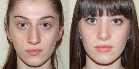 Girl before and after facial skin rejuvenation with plasma. 