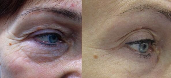 The result of effective plasma rejuvenation of the area around the eyes. 