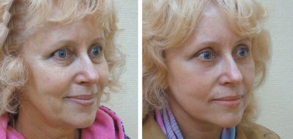 Woman before and after facial skin rejuvenation with plasma. 