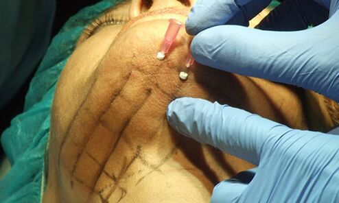 Thread lifting, a minimally invasive technique for facial skin rejuvenation